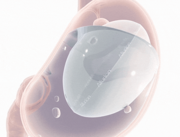 Gif - Ballon Allurion dans estomac.gif